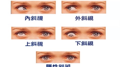 斜视矫正戴眼镜能治好吗？