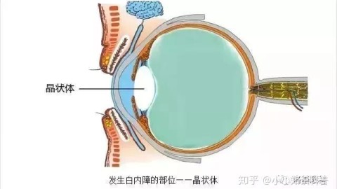 外伤性白内障术后，你的改装车需要一副懂运动的外挂镜头