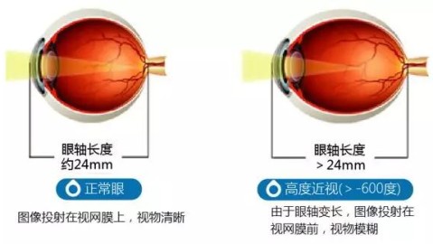 一、先理解高度近视，并非单纯的度数高