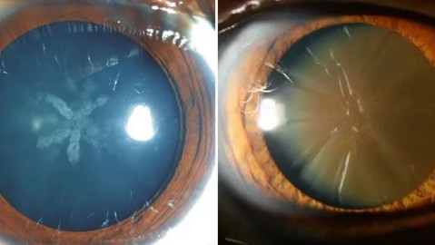 白内障术后度数不稳定？