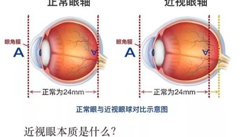 小框矫正眼镜不太适合高度散光，以下是具体分析