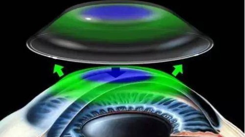 这个问题，或许正在屏幕前纠结——看着身边戴OK镜的孩子们白天不用架眼镜，打球、跑步、跳舞都特别方便，心里有点痒痒的，可又忍不住担心，这玩意儿压着眼球睡觉，会不会把角膜压坏了？是不是像老话说的，伤眼睛？