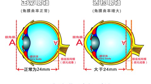 飞秒激光近视矫正术后需要多久科学恢复？