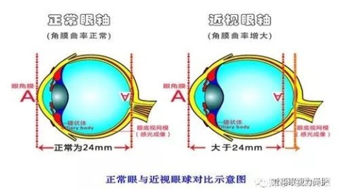 散瞳验光，到底是让度数涨了还是跌了？