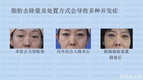 成人远视可以通过手术矫正，不过在选择手术前，需要权衡风险和收益。目前主要有以下几类手术方式可供选择