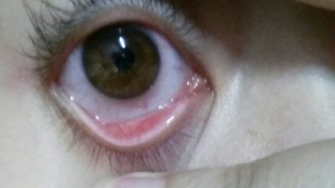 彩色美瞳矫正对眼睛有伤害吗？