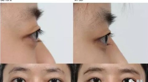 500度近视佩戴隐形眼镜，是需要减度数的