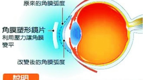 渐进多焦点矫正必须测瞳高吗
