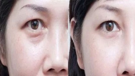 瞳高不对，确实会影响矫正视力
