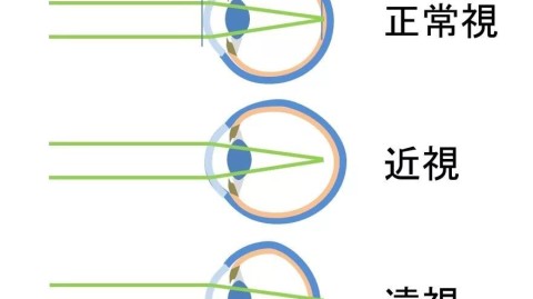 关于矫正视力手术后需要滴多久眼药水，这事儿分人，主要看手术方式、个人恢复速度和医生的具体方案，没有一刀切的标准答案
