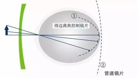 解密周边离焦镜片，它到底能不能控制近视？