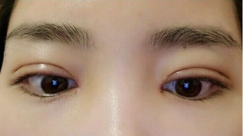 矫正视力后可以割双眼皮吗？