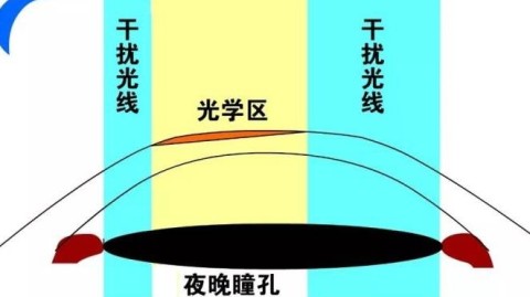 为什么术后夜间容易看不清？