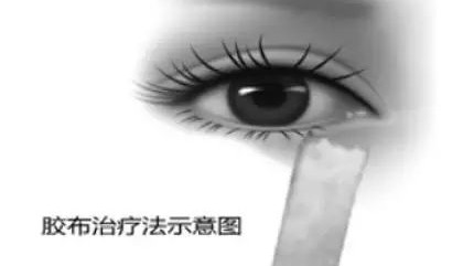 矫正手术后能否种睫毛，需根据手术类型和恢复情况具体分析