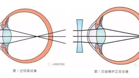 框架矫正眼镜究竟多久换一次？这并没有一个放之四海而皆准的绝对时间，而是需要根据佩戴者的年龄、镜片的老化程度以及镜架的变形情况来综合判断